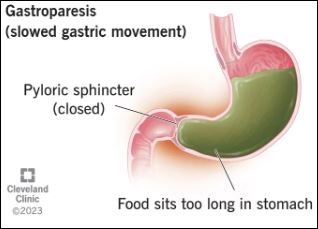 Gastroparesis