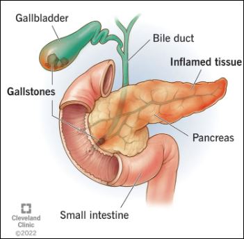 Pancreatitis for GLP-1 may be acute or chronic, mild or severe
